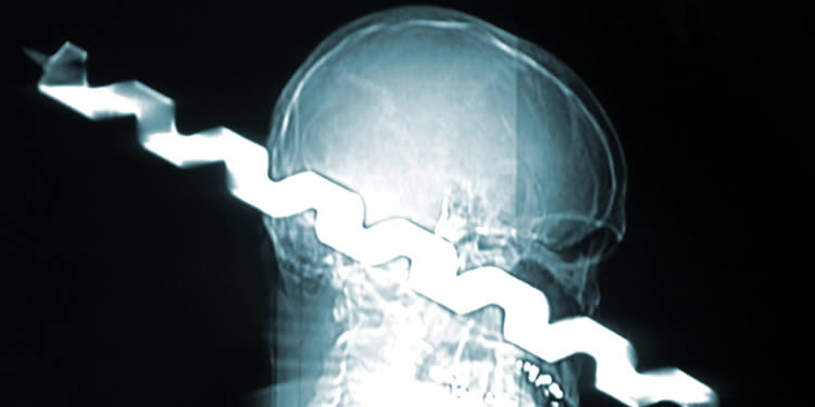 The largest object removed from the human skull was a drill bit.